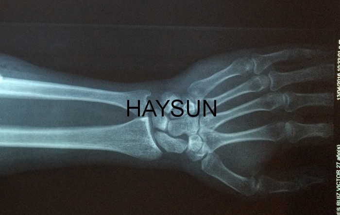 图片关键词 wrist_xray_cc0_pixabay.jpg
